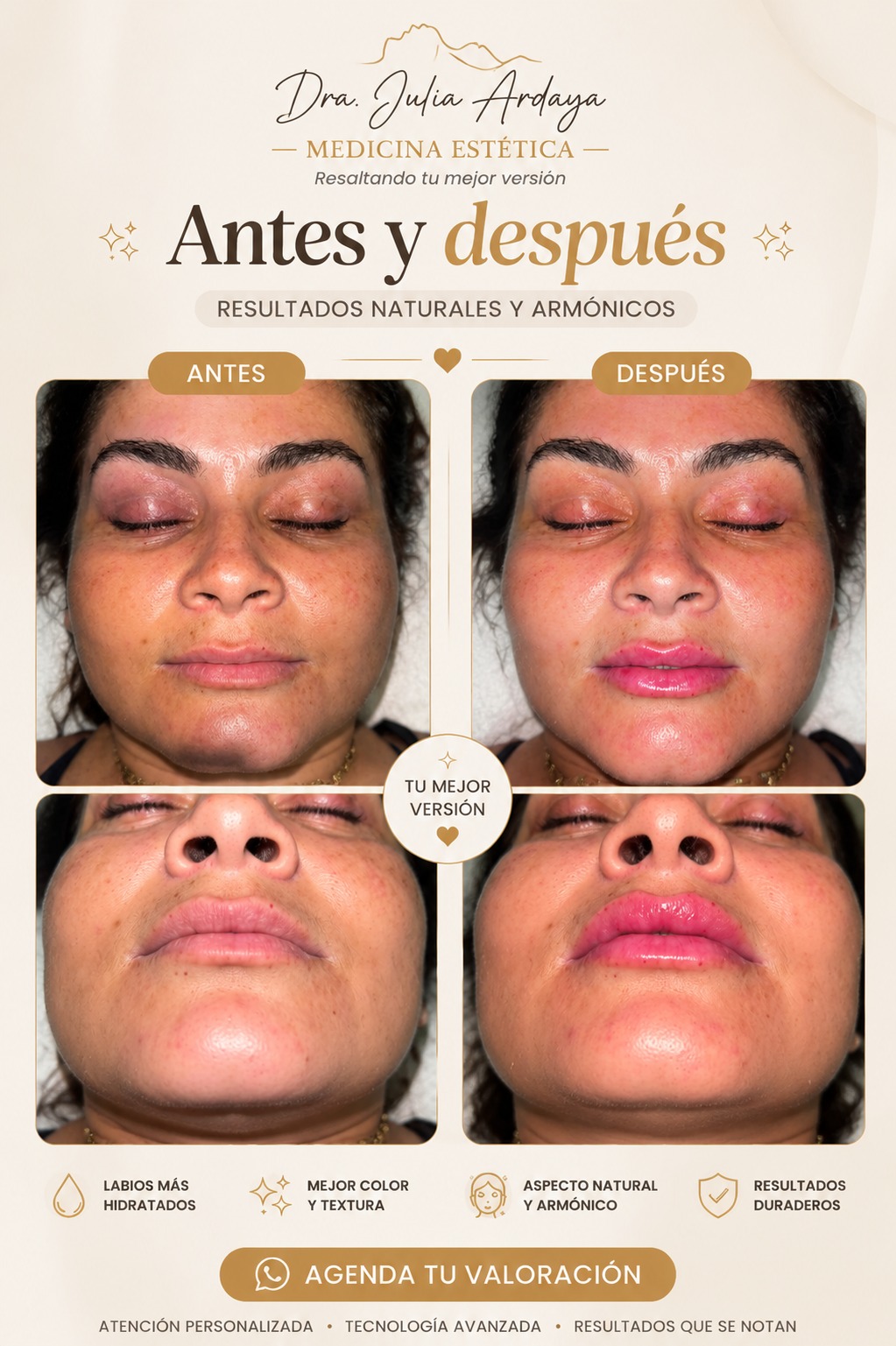 Antes y después de tratamiento — Dra. Julia Ardaya